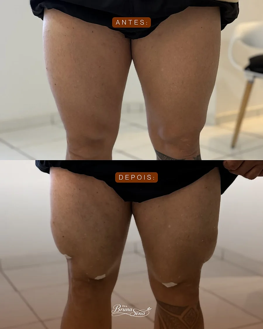 Resultado: Antes e depois